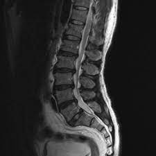 spinal